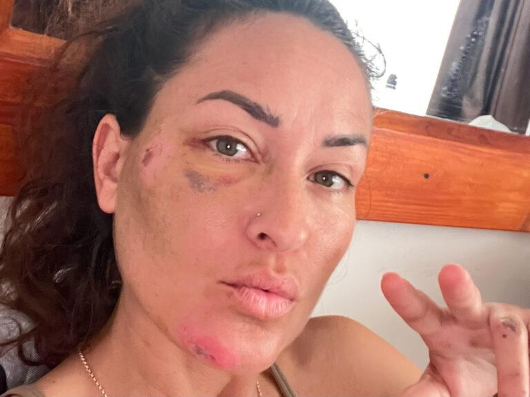 Celia tras el accidente de moto en Paracas, Perú